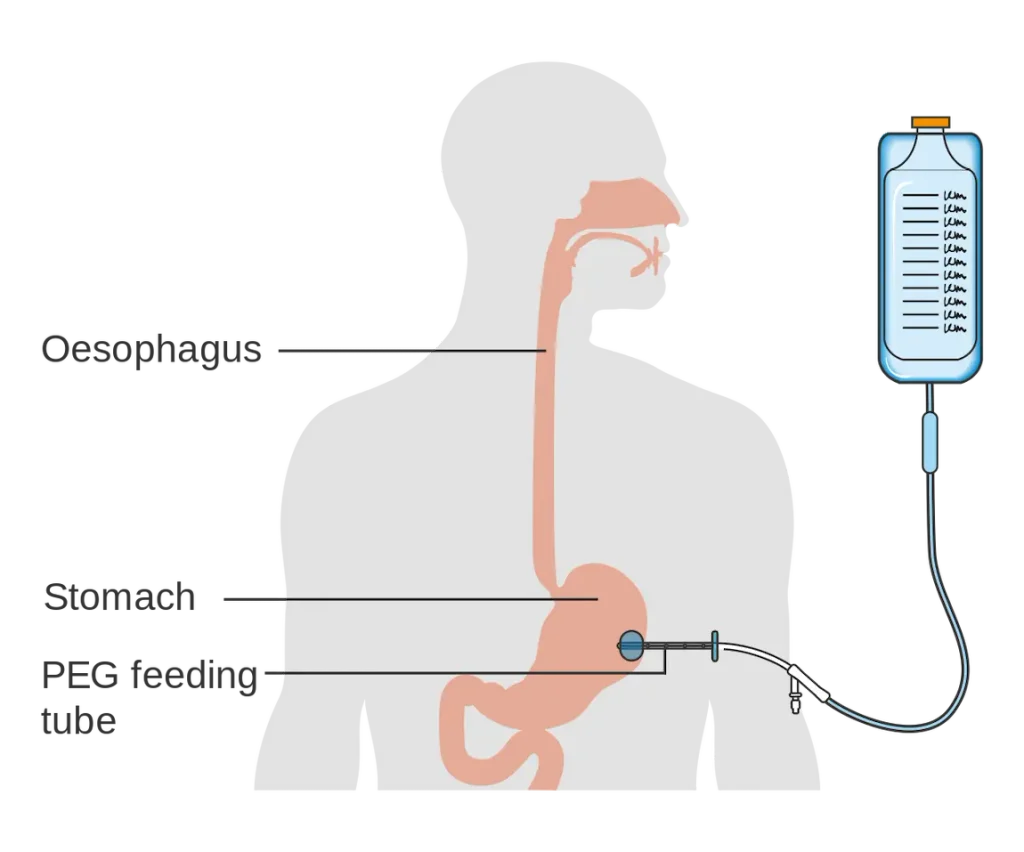 PEG tube and tracheostomy care at home